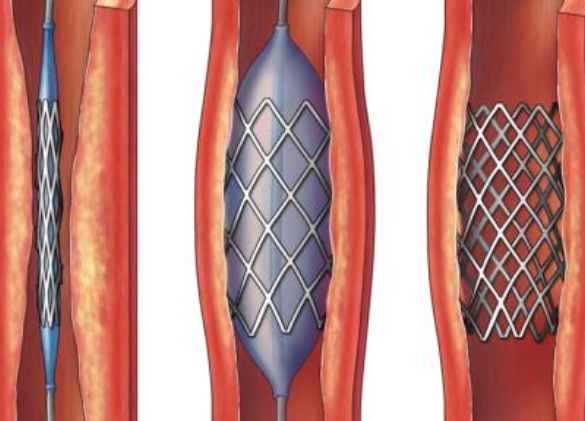 好消息！700元冠脈支架來了帶量采購結(jié)果在甘肅省正式落地執(zhí)行